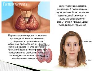  клинический синдром, вызванный повышением гормональной активности щитовидной же