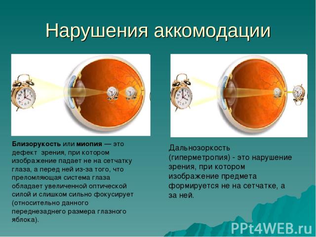 Нарушения аккомодации Дальнозоркость (гиперметропия) - это нарушение зрения, при котором изображение предмета формируется не на сетчатке, а за ней. Близорукость или миопия — это дефект зрения, при котором изображение падает не на сетчатку глаза, а п…