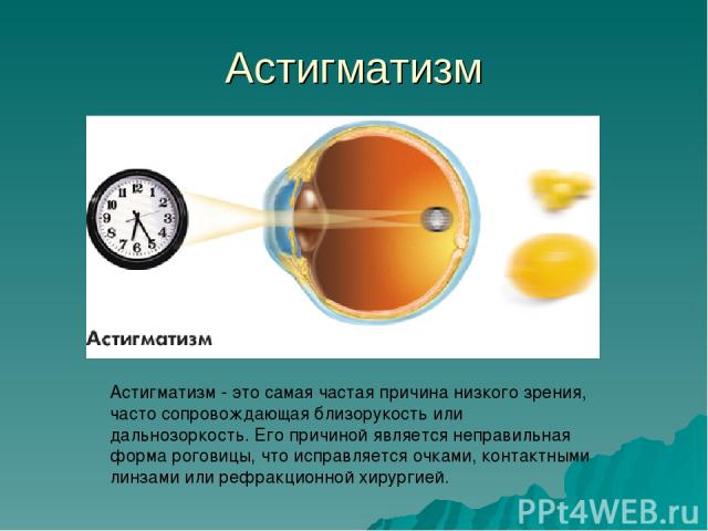 Астигматизм Астигматизм - это самая частая причина низкого зрения, часто сопровождающая близорукость или дальнозоркость. Его причиной является неправильная форма роговицы, что исправляется очками, контактными линзами или рефракционной хирургией.