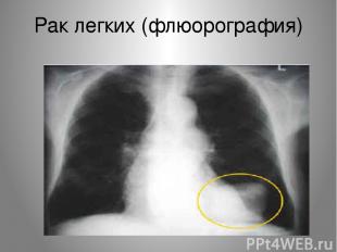 Рак легких (флюорография)