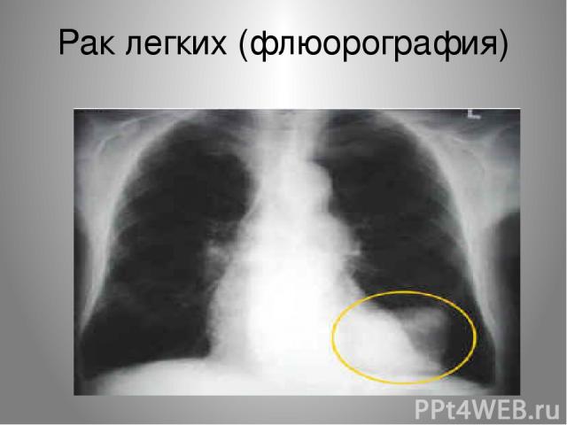 Рак легких (флюорография)