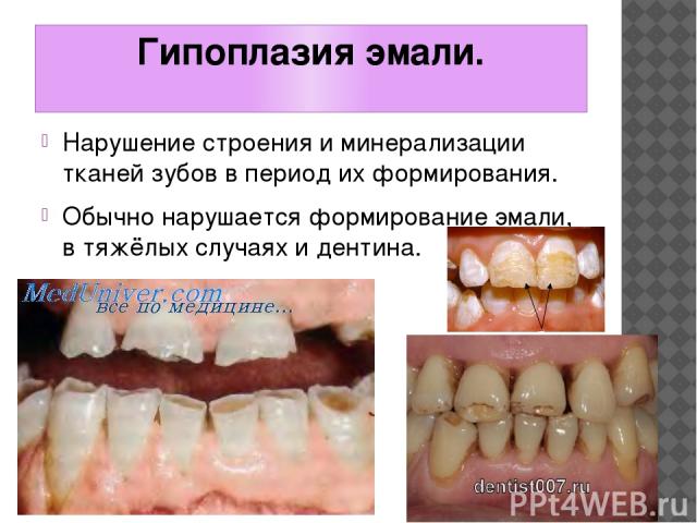 Гипоплазия эмали. Нарушение строения и минерализации тканей зубов в период их формирования. Обычно нарушается формирование эмали, в тяжёлых случаях и дентина.