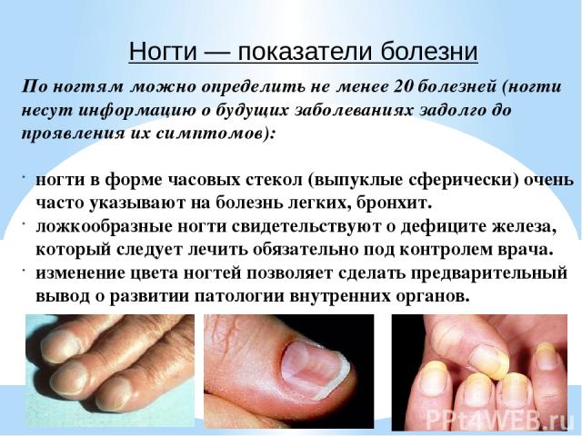 По ногтям можно определить не менее 20 болезней (ногти несут информацию о будущих заболеваниях задолго до проявления их симптомов): ногти в форме часовых стекол (выпуклые сферически) очень часто указывают на болезнь легких, бронхит. ложкообразные но…