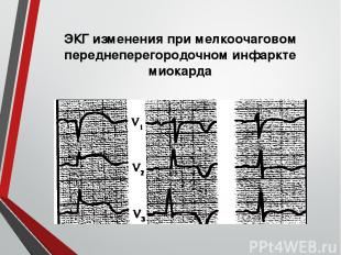 ЭКГ изменения при мелкоочаговом переднеперегородочном инфаркте миокарда