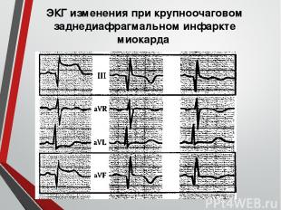 ЭКГ изменения при крупноочаговом заднедиафрагмальном инфаркте миокарда