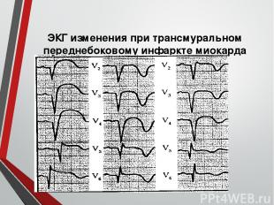 ЭКГ изменения при трансмуральном переднебоковому инфаркте миокарда