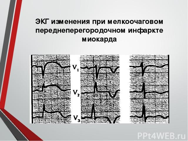 ЭКГ изменения при мелкоочаговом переднеперегородочном инфаркте миокарда