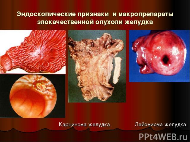 Эндоскопические признаки и макропрепараты злокачественной опухоли желудка Карцинома желудка Лейомиома желудка