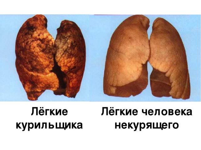 Лёгкие курильщика Лёгкие человека некурящего