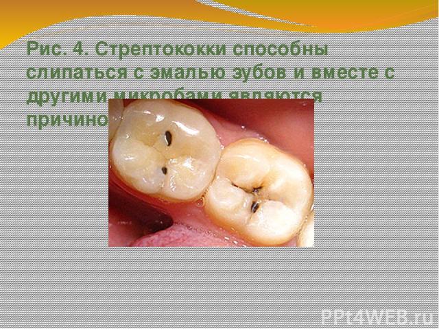 Рис. 4. Стрептококки способны слипаться с эмалью зубов и вместе с другими микробами являются причиной кариеса.