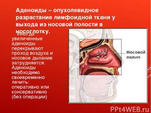 Аденоиды – опухолевидное разрастание лимфоидной ткани у выхода из носовой полост