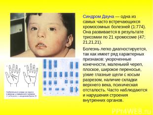 Синдром Дауна — одна из самых часто встречающихся хромосомных болезней (1:774).