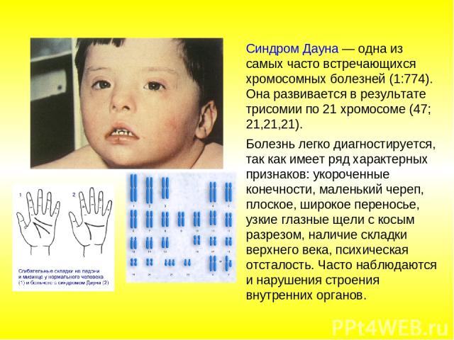 Синдром Дауна — одна из самых часто встречающихся хромосомных болезней (1:774). Она развивается в результате трисомии по 21 хромосоме (47; 21,21,21). Болезнь легко диагностируется, так как имеет ряд характерных признаков: укороченные конечности, мал…