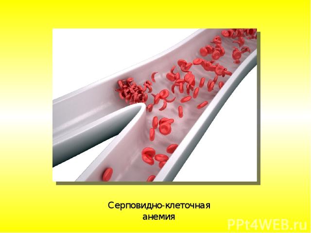Серповидно-клеточная анемия