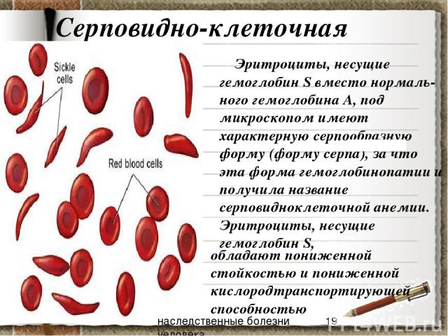 Серповидно-клеточная анемия Эритроциты, несущие гемоглобин S вместо нормаль-ного гемоглобина А, под микроскопом имеют характерную серпообразную форму (форму серпа), за что эта форма гемоглобинопатии и получила название серповидноклеточной анемии. Эр…