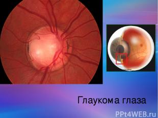 Глаукома глаза
