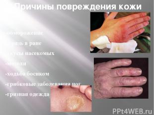 Причины повреждения кожи -ожог -обморожение - грязь в ране -укусы насекомых -моз