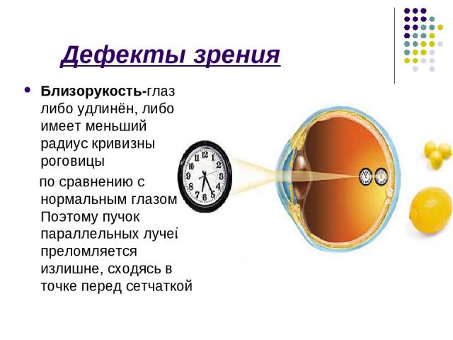 Дефекты зрения Близорукость-глаз либо удлинён, либо имеет меньший радиус кривизны роговицы по сравнению с нормальным глазом. Поэтому пучок параллельных лучей преломляется излишне, сходясь в точке перед сетчаткой
