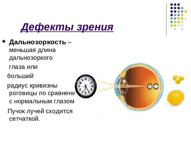 Дефекты зрения Дальнозоркость – меньшая длина дальнозоркого глаза или больший радиус кривизны роговицы по сравнению с нормальным глазом. Пучок лучей сходится за сетчаткой.