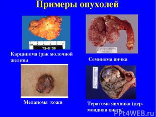 Примеры опухолей Карцинома (рак молочной железы Семинома яичка Меланома кожи Тер