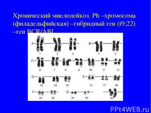 Хронический миелолейкоз. Ph –хромосома (филадельфийская) –гибридный ген (t9;22)