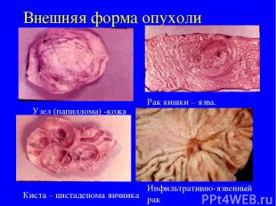 Внешняя форма опухоли Узел (папиллома) -кожа Рак кишки – язва. Киста – цистадено