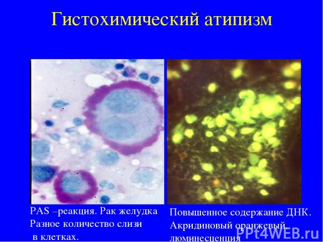Гистохимический атипизм PAS –реакция. Рак желудка Разное количество слизи в клетках. Повышенное содержание ДНК. Акридиновый оранжевый. люминесценция