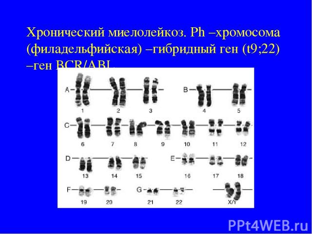 Хронический миелолейкоз. Ph –хромосома (филадельфийская) –гибридный ген (t9;22) –ген BCR/ABL