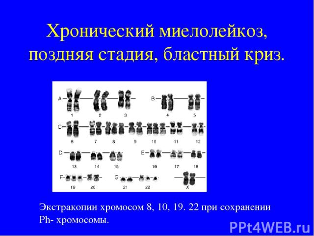 Хронический миелолейкоз, поздняя стадия, бластный криз. Экстракопии хромосом 8, 10, 19. 22 при сохранении Ph- хромосомы.