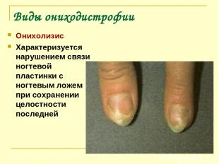 Виды ониходистрофии Онихолизис Характеризуется нарушением связи ногтевой пластин