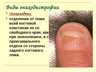 Виды ониходистрофии Онихомадезис отделение от ложа всей ногтевой пластинки не со