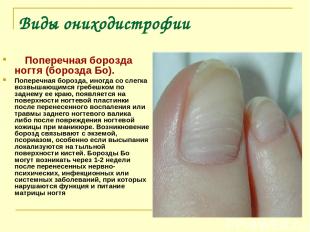 Виды ониходистрофии      Поперечная борозда ногтя (борозда Бо). Поперечная бороз