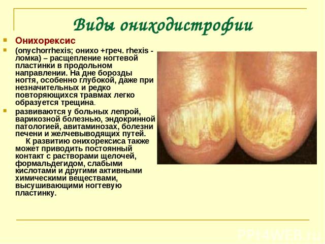 Виды ониходистрофии Онихорексис (onychorrhexis; онихо +греч. rhexis - ломка) – расщепление ногтевой пластинки в продольном направлении. На дне борозды ногтя, особенно глубокой, даже при незначительных и редко повторяющихся травмах легко образуется т…