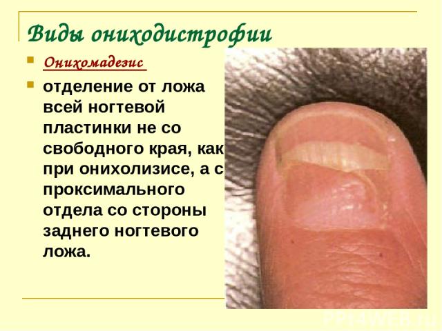 Виды ониходистрофии Онихомадезис отделение от ложа всей ногтевой пластинки не со свободного края, как при онихолизисе, а с проксимального отдела со стороны заднего ногтевого ложа.