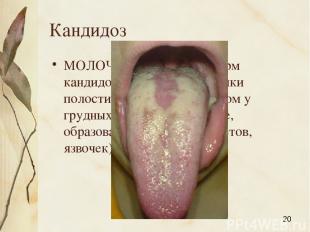 Кандидоз МОЛОЧНИЦА, одна из форм кандидоза слизистой оболочки полости рта, главн