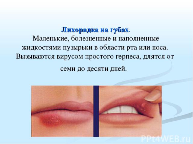  Лихорадка на губах. Маленькие, болезненные и наполненные жидкостями пузырьки в области рта или носа. Вызываются вирусом простого герпеса, длятся от семи до десяти дней.