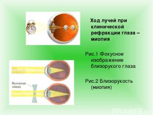 Ход лучей при клинической рефракции глаза – миопия Рис.1 Фокусное изображение бл