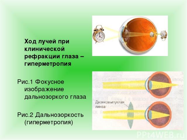 Ход лучей при клинической рефракции глаза – гиперметропия Рис.1 Фокусное изображение дальнозоркого глаза Рис.2 Дальнозоркость (гиперметропия)