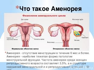 Что такое Аменорея Аменорея - отсутствие менструации в течение 6 мес и более. Ам