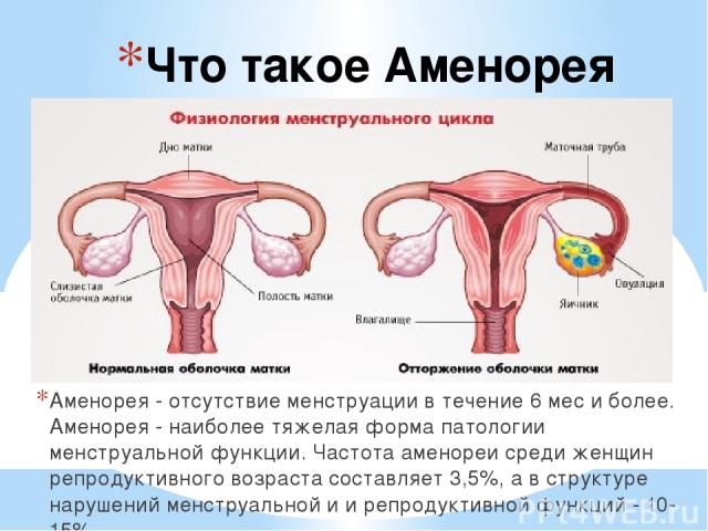 Что такое Аменорея Аменорея - отсутствие менструации в течение 6 мес и более. Аменорея - наиболее тяжелая форма патологии менструальной функции. Частота аменореи среди женщин репродуктивного возраста составляет 3,5%, а в структуре нарушений менструа…