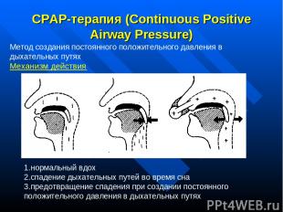 СРАР-терапия (Continuous Positive Airway Pressure) Метод создания постоянного по