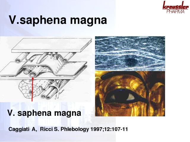 V. saphena magna Caggiati. A, Ricci S. Phlebology 1997;12:107-11 V.saphena magna