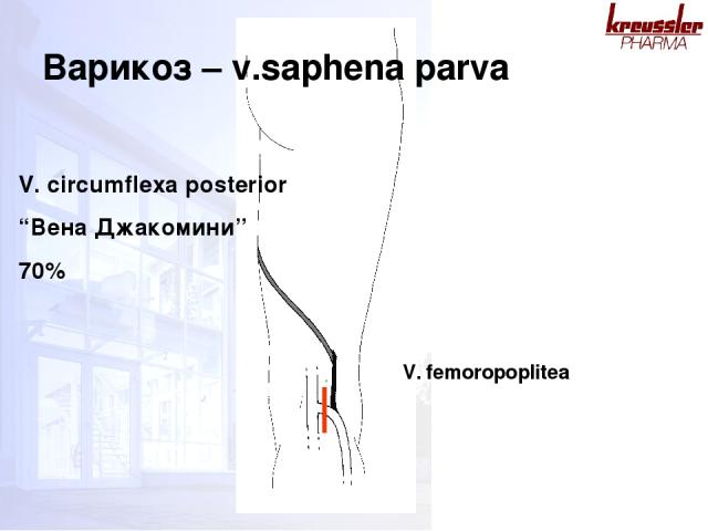 V. circumflexa posterior “Вена Джакомини” 70% V. femoropoplitea Варикоз – v.saphena parva