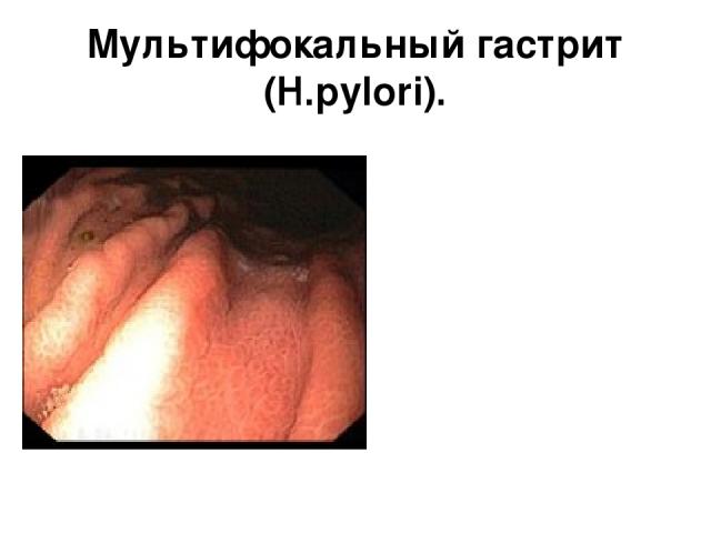 Мультифокальный гастрит (H.pylori).