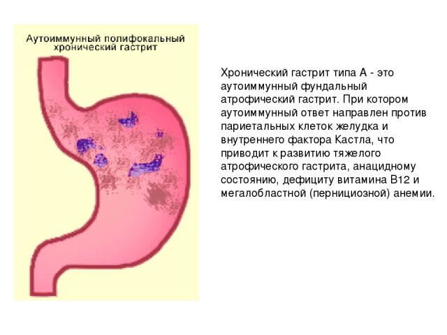 гипертонический желудок