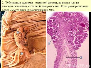 2- Тубулярные аденомы - округлой формы, на ножке или на плоском основании, с гла