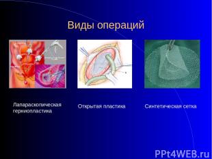 Виды операций Лапараскопическая герниопластика Открытая пластика Синтетическая с