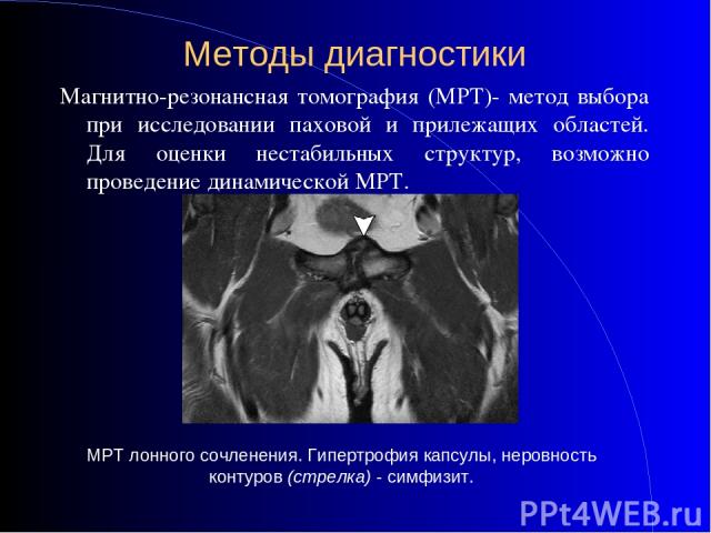 Методы диагностики Магнитно-резонансная томография (МРТ)- метод выбора при исследовании паховой и прилежащих областей. Для оценки нестабильных структур, возможно проведение динамической МРТ. МРТ лонного сочленения. Гипертрофия капсулы, неровность ко…