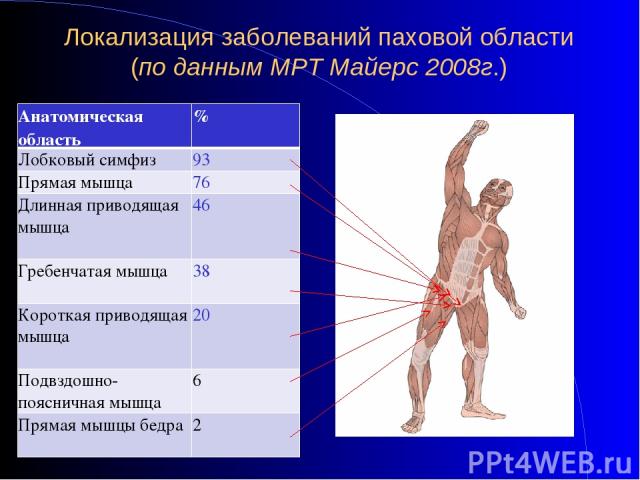 Локализация заболеваний паховой области (по данным МРТ Майерс 2008г.) Анатомическая область % Лобковый симфиз 93 Прямая мышца 76 Длинная приводящая мышца 46 Гребенчатая мышца 38 Короткая приводящая мышца 20 Подвздошно-поясничная мышца 6 Прямая мышцы…