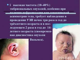 ● высокая частота (10–40%) эмбриональных опухолей, особенно при наличии нефромег